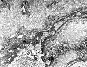 jejunum … lipid malabsorption